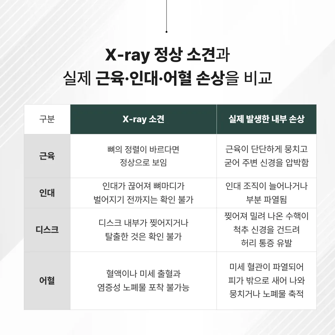 교통사고 허리 X-ray 정상 근육 인대 어혈 손상