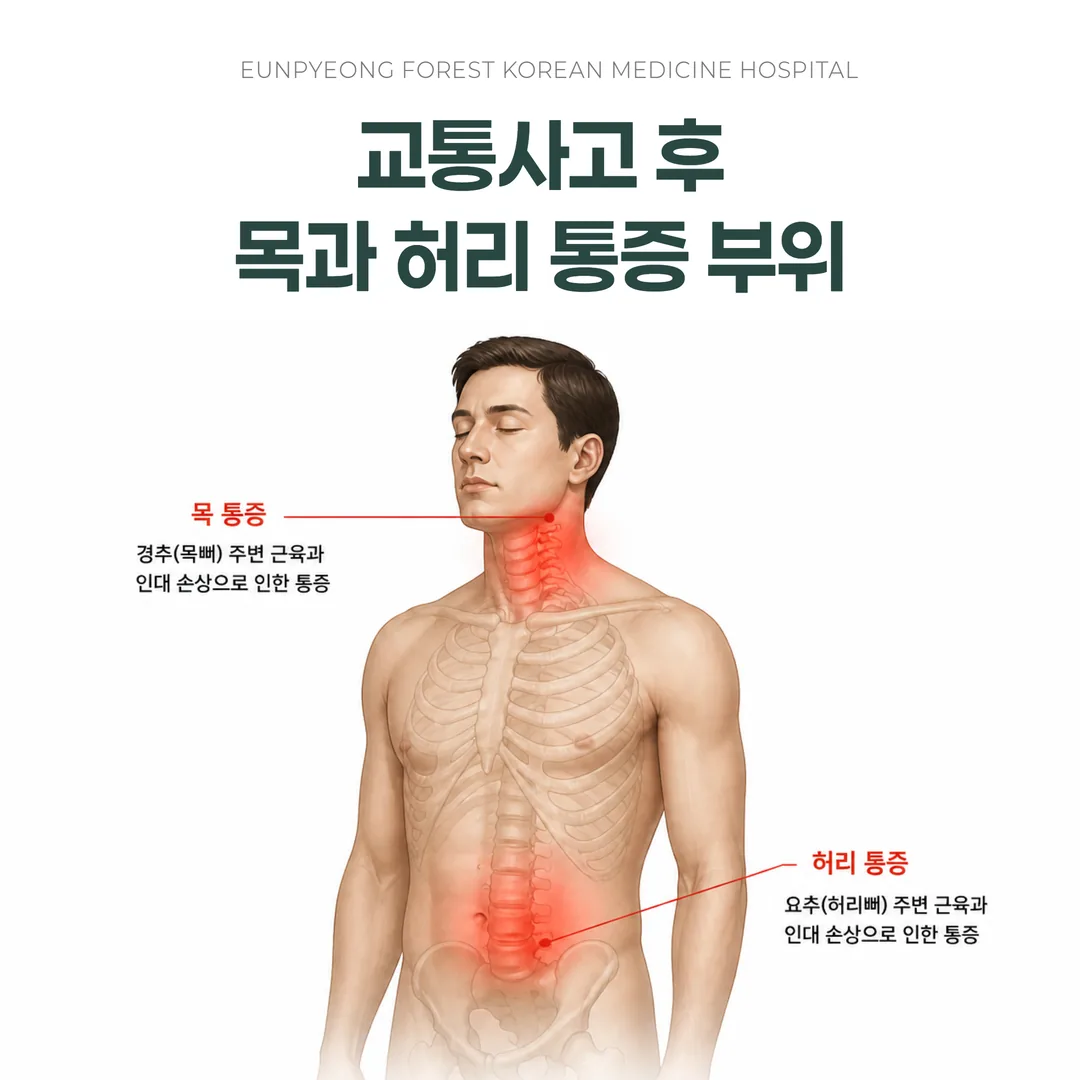 교통사고 후유증으로 통증이 나타나는 목·허리 부위를 표시한 그림