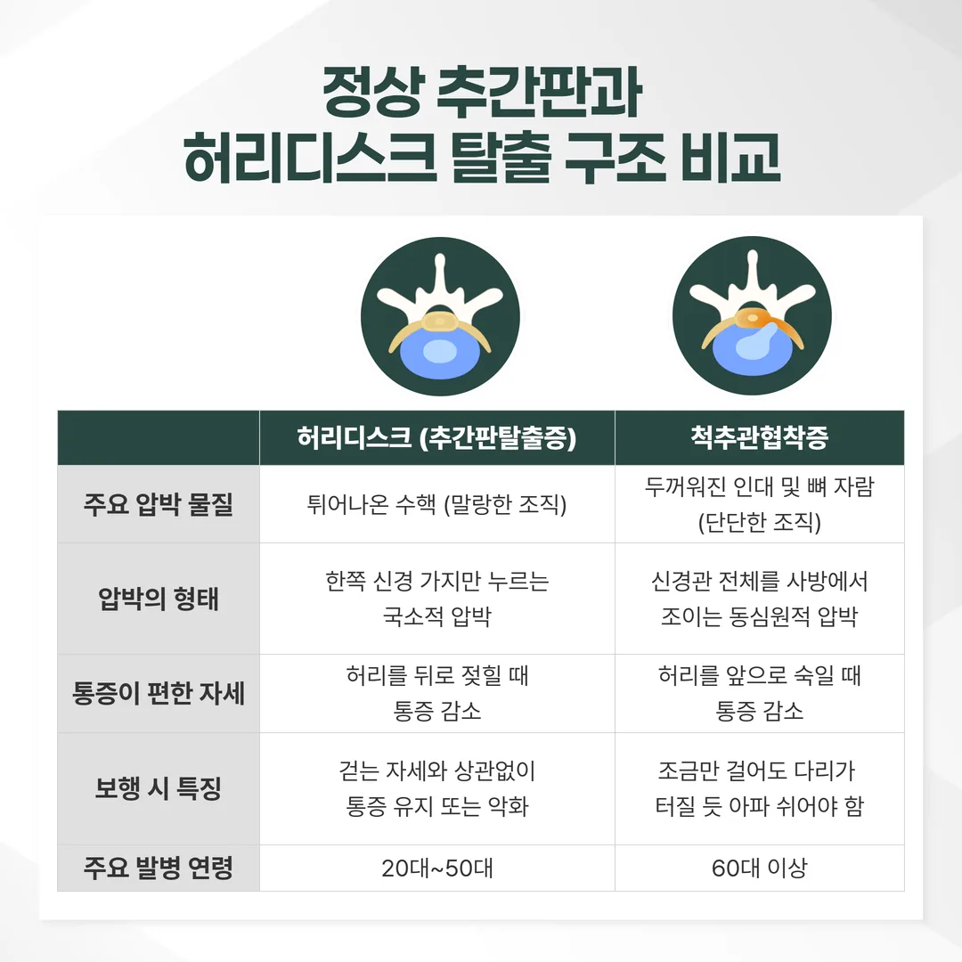 정상 추간판과 허리디스크 탈출 구조 비교