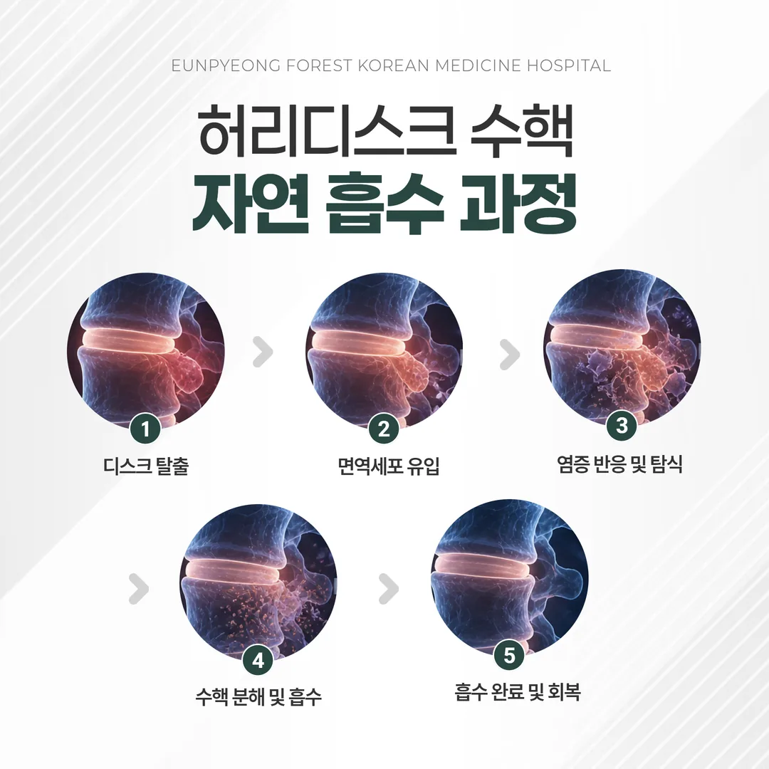 허리디스크 수핵 자연 흡수 과정