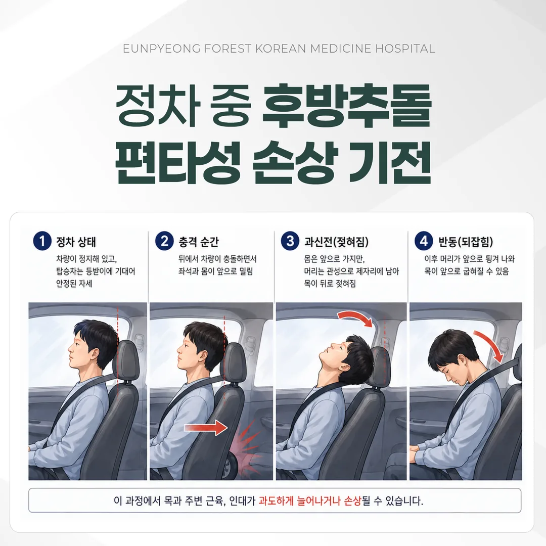 정차 중 후방추돌에서 목이 젖혀지는 편타성 손상 기전 도해