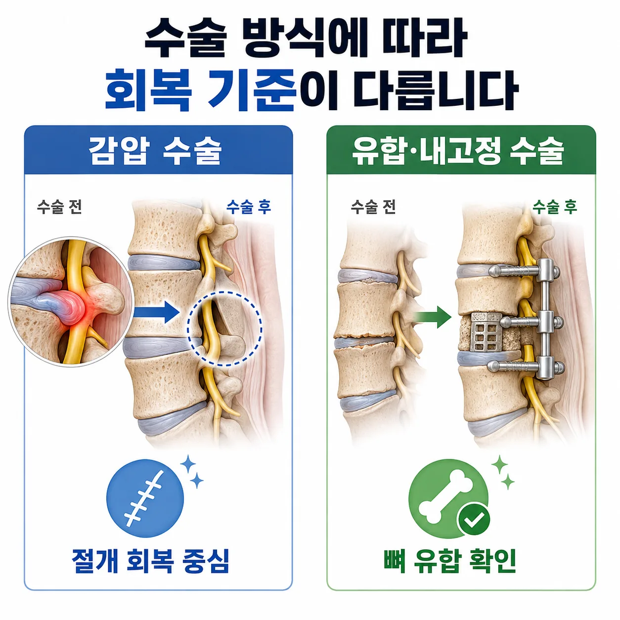 허리 수술 방식에 따라 회복을 기다리는 대상이 다름을 보여 주는 도해