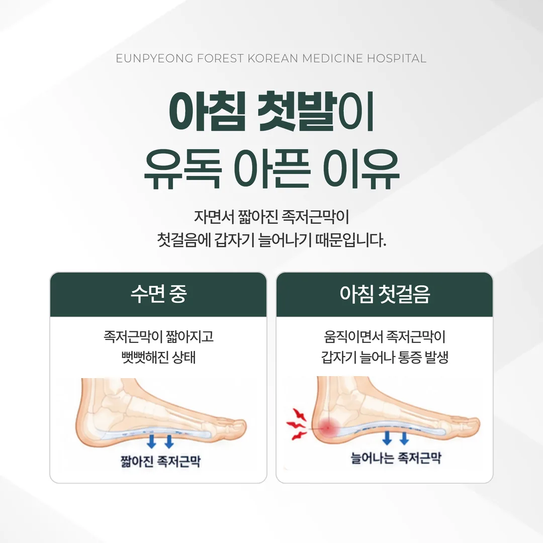 족저근막의 위치와 수면 중 단축·첫걸음 신장을 두 단계로 나타낸 개념도