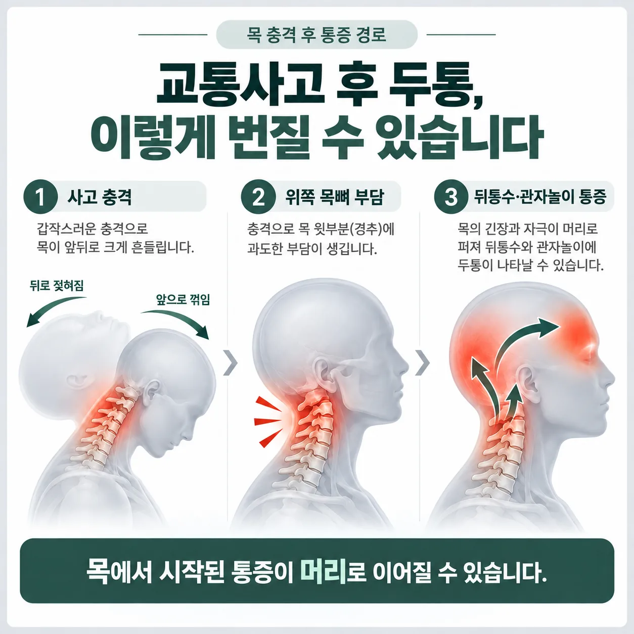 교통사고 때 목이 젖혀지며 위쪽 목뼈에서 뒤통수와 관자놀이로 통증이 번지는 경로 개념도