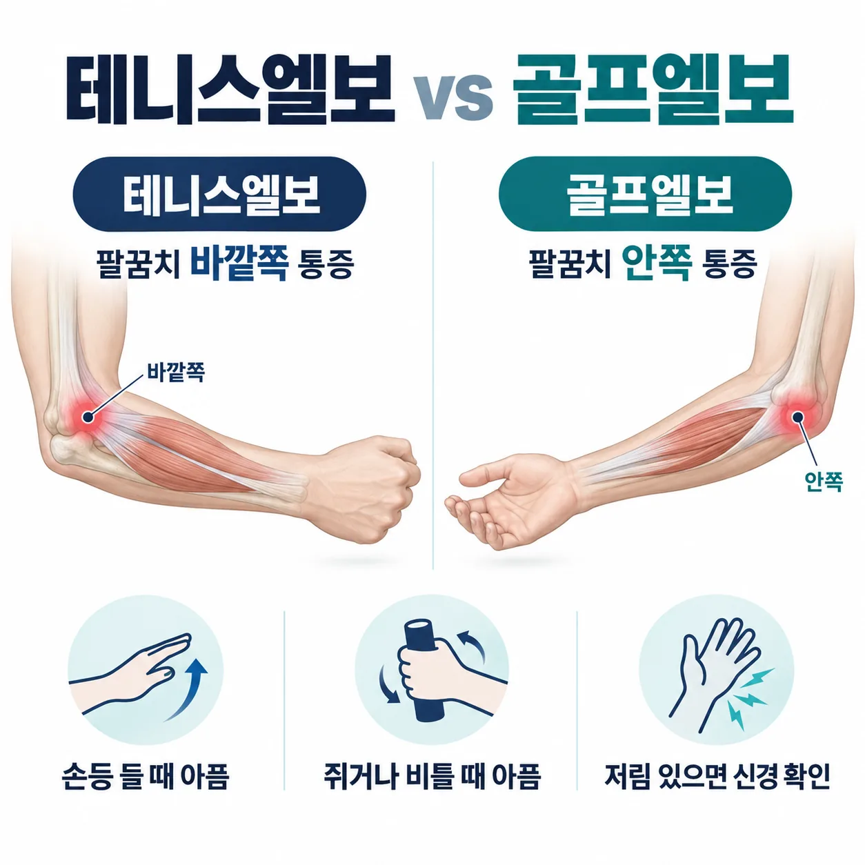 테니스엘보와 골프엘보의 통증 부위를 비교한 그림