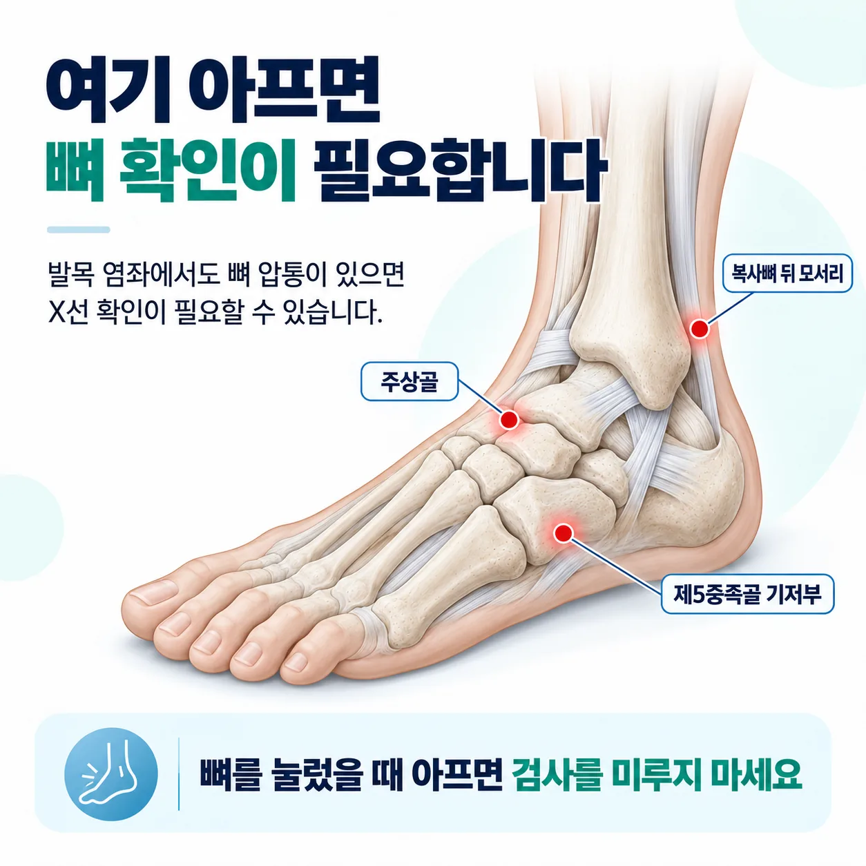 발목 염좌에서 X선 확인이 필요한 뼈 압통 부위를 표시한 도해