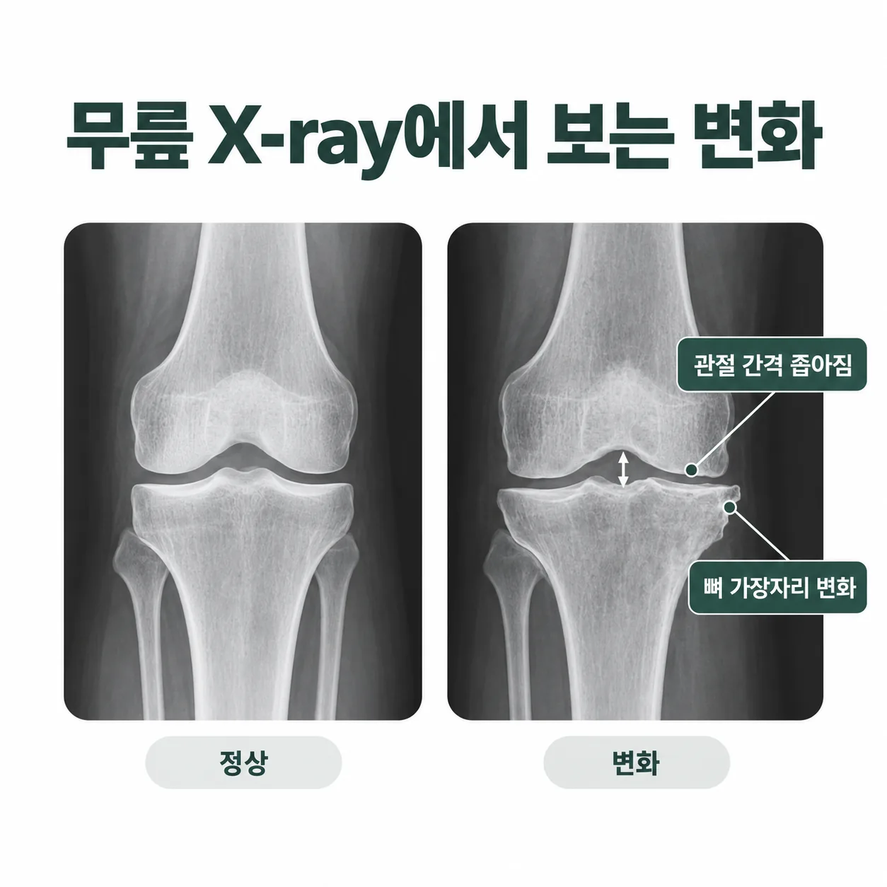 무릎 X-ray에서 보는 뼈 사이 간격과 뼈 가장자리 변화 개념도