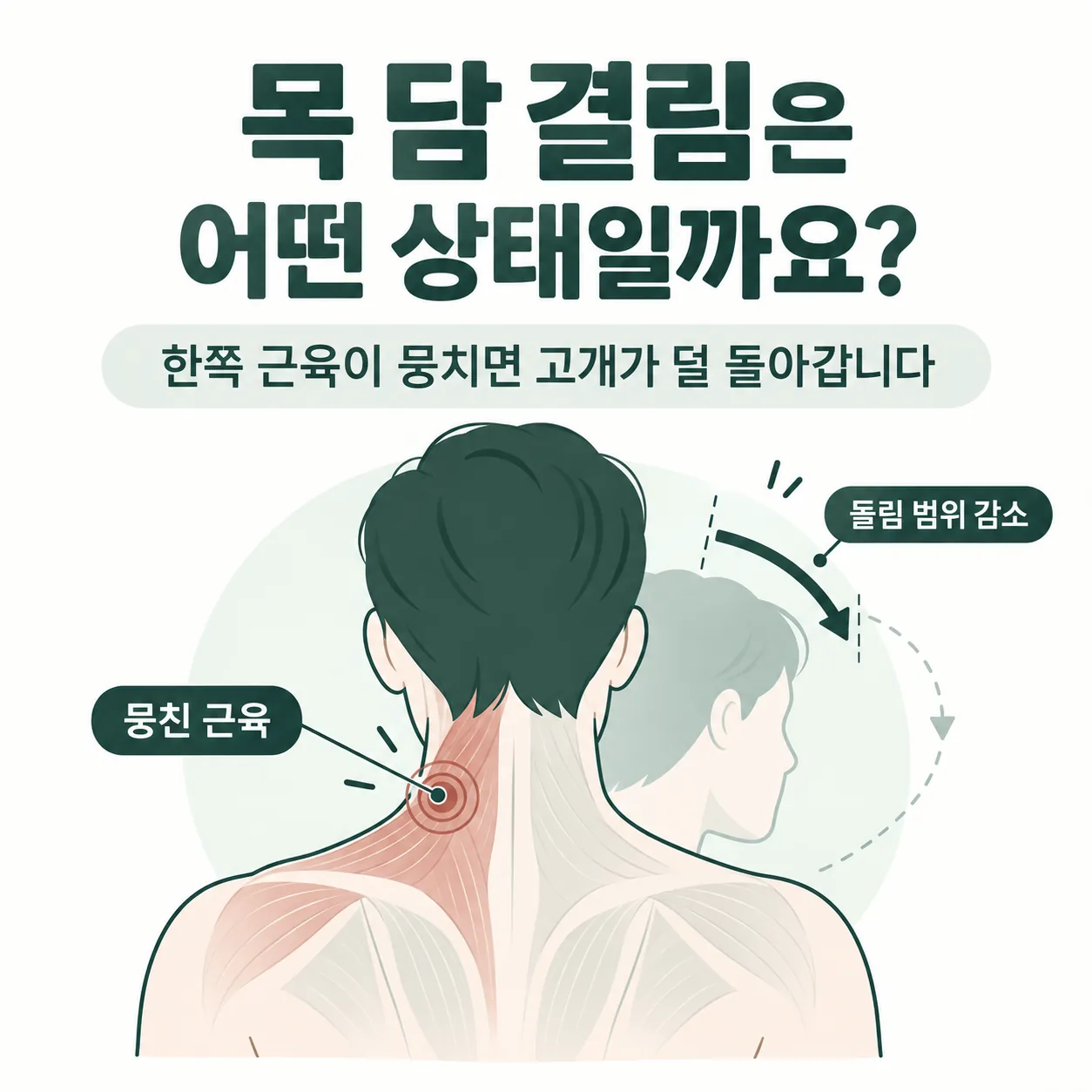 목 담 결림으로 한쪽 근육이 뭉쳐 고개 돌리는 범위가 줄어든 상태를 나타낸 개념도