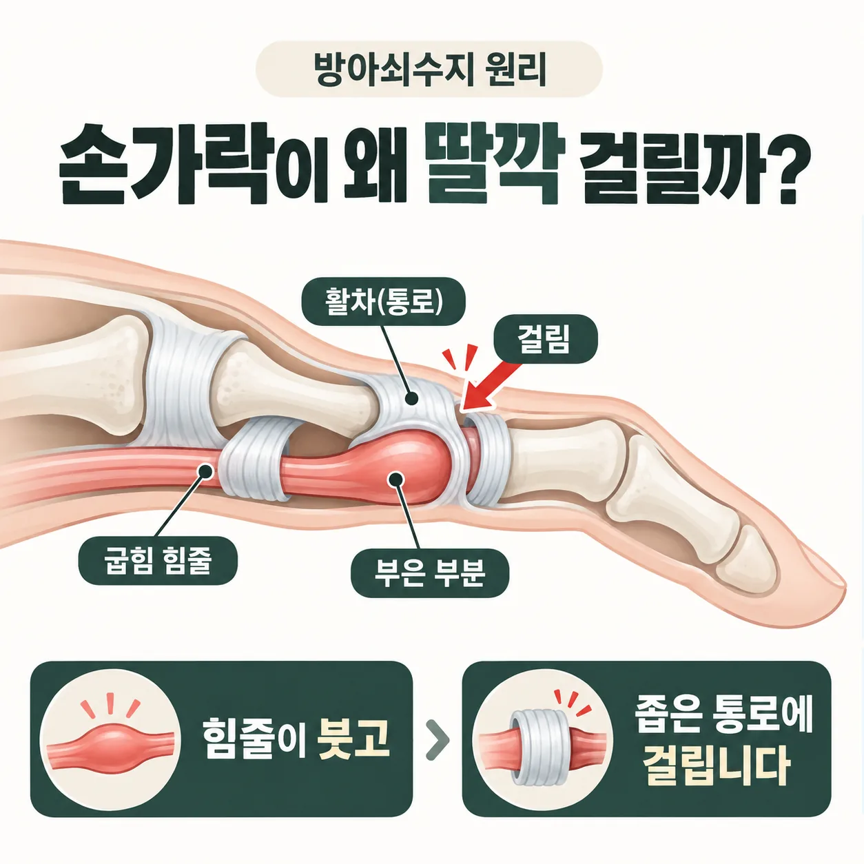 방아쇠수지에서 굵어진 굽힘 힘줄이 손가락 뿌리 통로에 막히는 원리 도식